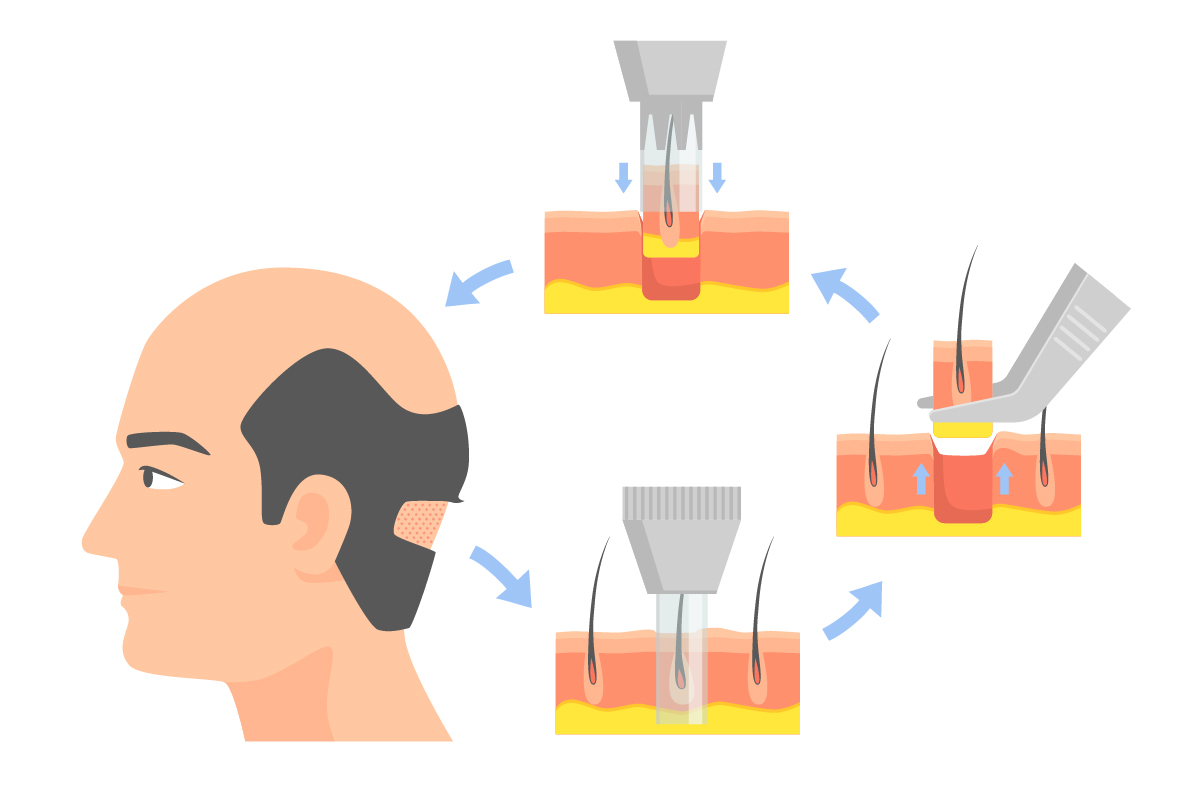 Бесшовная пересадка волос ФУЕ (FUE — Follicular Unit Extraction) Бесшовная пересадка волос ФУЕ (FUE — Follicular Unit Extraction)