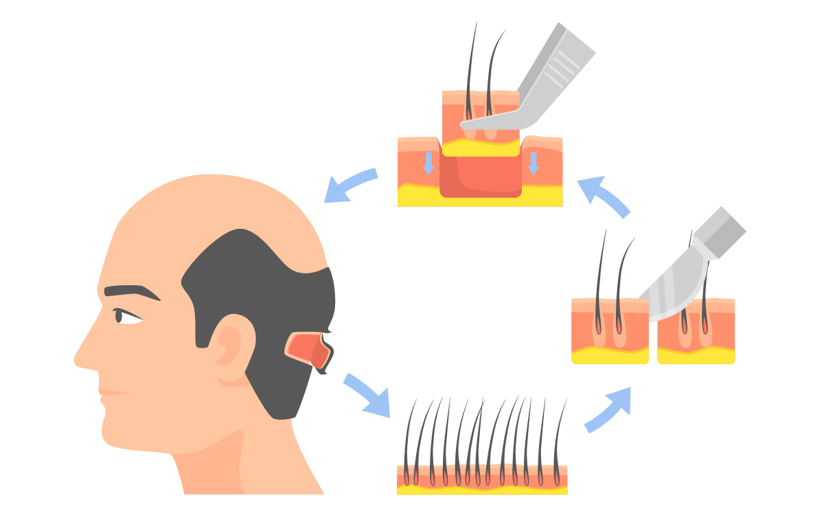 Лоскутная пересадка FUT (Follicular Unit Transplantation)/STRIP Лоскутная пересадка FUT (Follicular Unit Transplantation)/STRIP