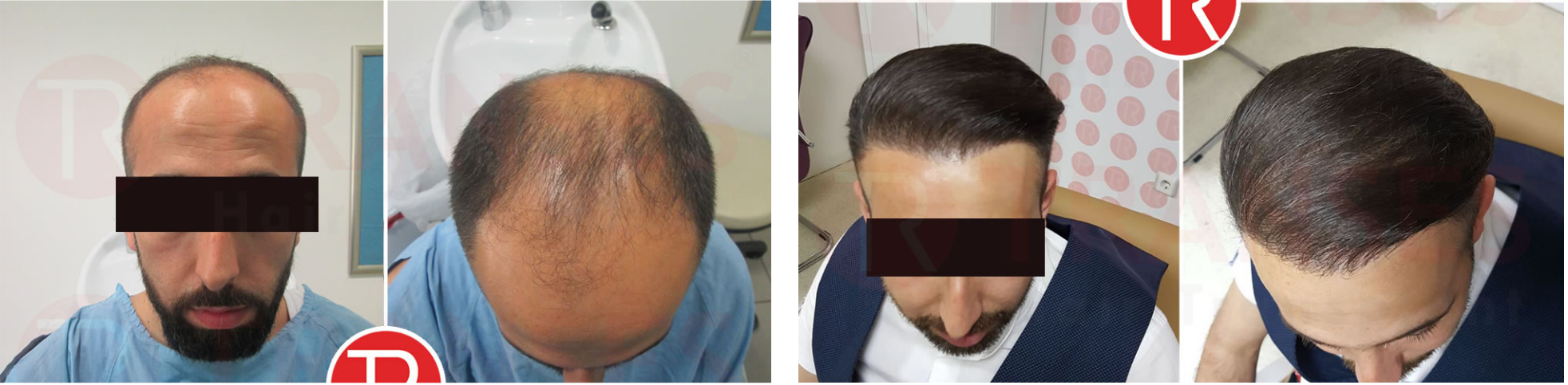 Before & after photo of hair transplant