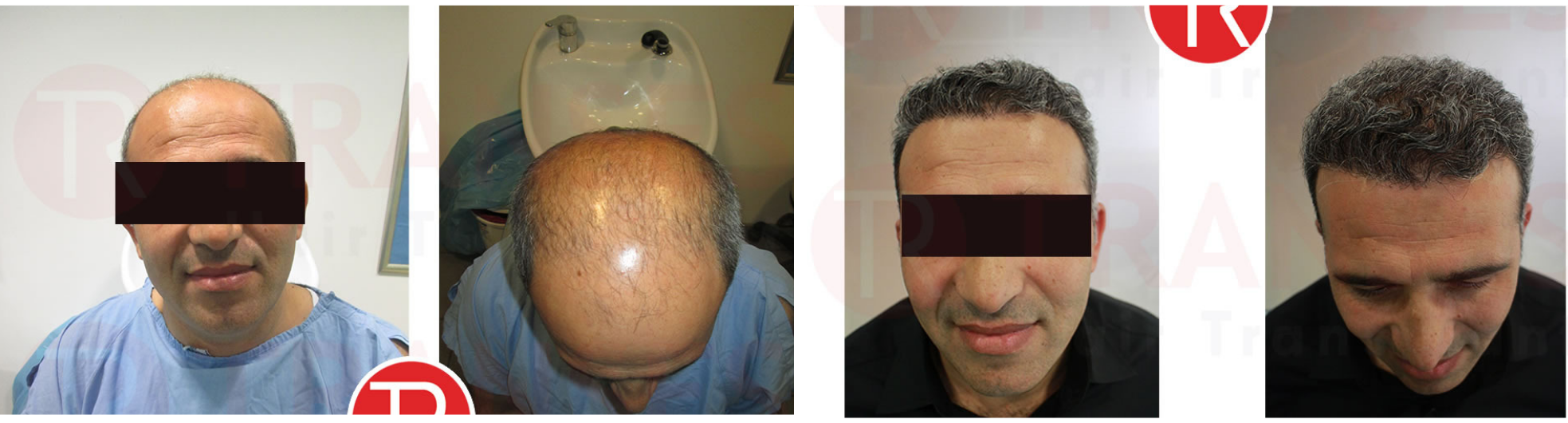 Before & after photo of hair transplant