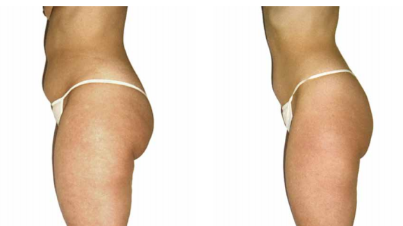 Body correction at Lemanic Body correction in Clinic Lémanic