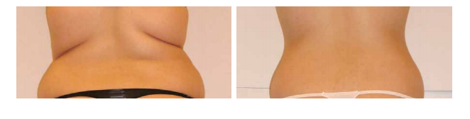 Cryolipolysis at Lemanic Cryolipolysis in Clinic Lémanic