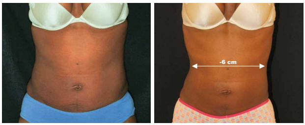 Cryolipolysis in Clinic Lemanic Cryolipolysis at Lemanic