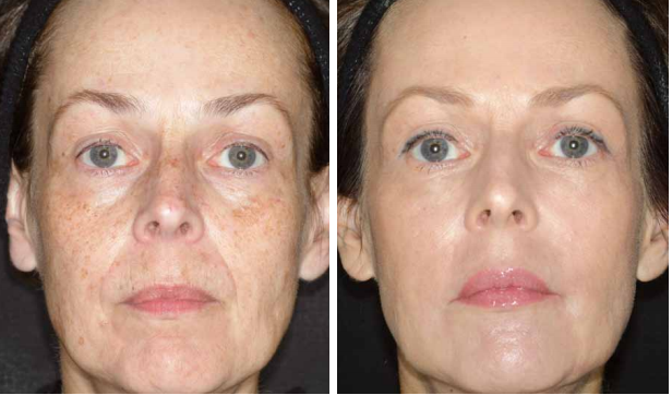 Face rejuvenation at Lemanic Face rejuvenation in Lemanic Clinic