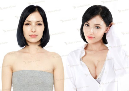 Фото до и после увеличения бюста в клинике JK Plastic Surgery (Джей Кей Пластик Серджери) в Сеуле, Южная Корея Фото до и после увеличения бюста в клинике JK Plastic Surgery (Джей Кей Пластик Серджери) в Сеуле, Южная Корея