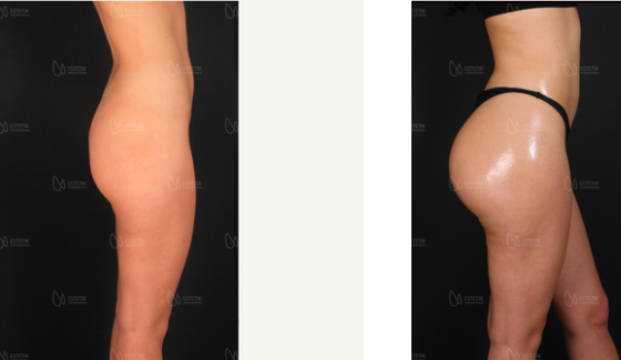 Brazilian Buttock Lift Cost Compare Prices Worldwide