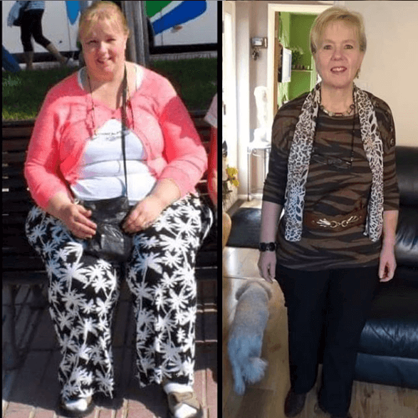 Bariatric surgery at KCM: before-after Before and after weight loss surgery at KCM, Poland