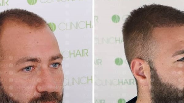 Before and after hair transplant at ClinicHair in Turkey Before-after hair transplant in Izmir