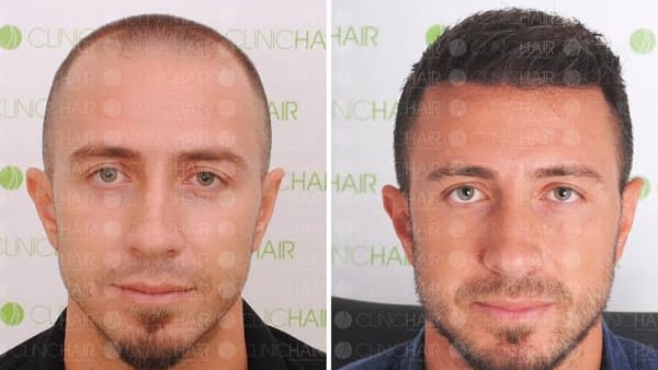 Before&after hair transplant at ClinicHair Before and after hair transplant at Turkish ClinicHair