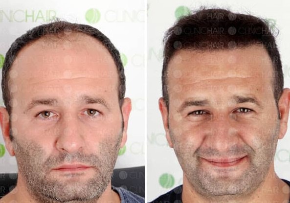 ClinicHair before-after hair transplant Before-after hair transplant photos in turkey