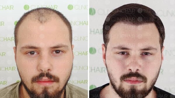 Before-after FUE hair implantation at ClinicHair in Turkey FUE Hair transplantation at Turkish ClinicHair