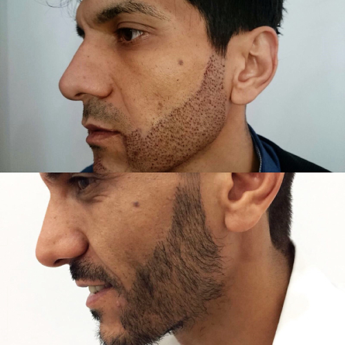 Photo of beard after transplant Фото бороды после пересадки