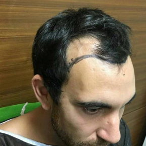 Фото до пересадки волос